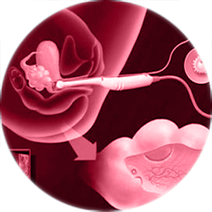 endometrioma