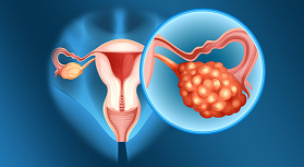 ovarian cyst