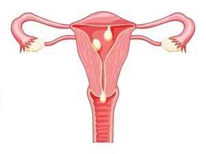 uterine polyp