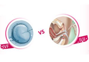 IVF pregnancy