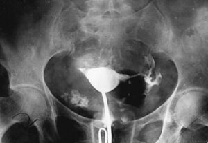 Cause of hysterosalpingography