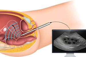 hysterosonography