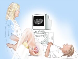 internal ultrasound