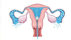 sono in water or sonohysterography