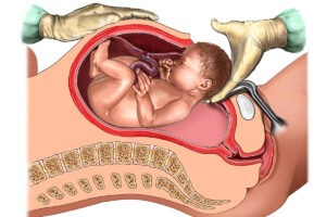 زایمان سزارین