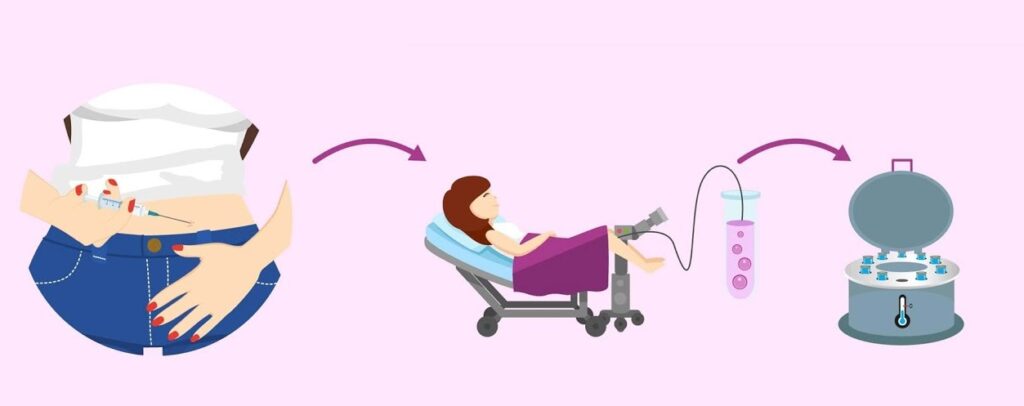 عمل فریز تخمک