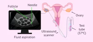 تخمک کشی یا پانکچر