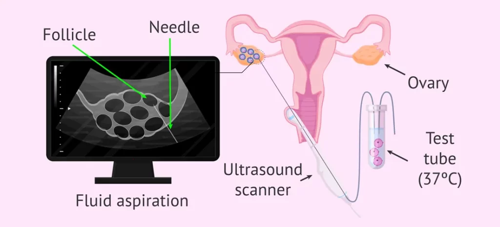 تخمک کشی یا پانکچر